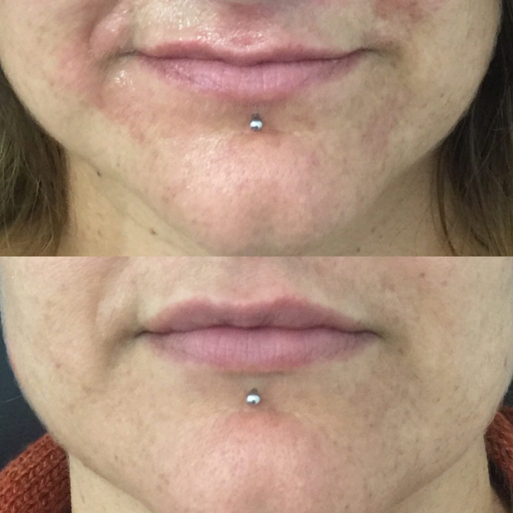 Lip Filler Brisbane Lip Injections 1ml Lip Filler Natural Lip Fillers