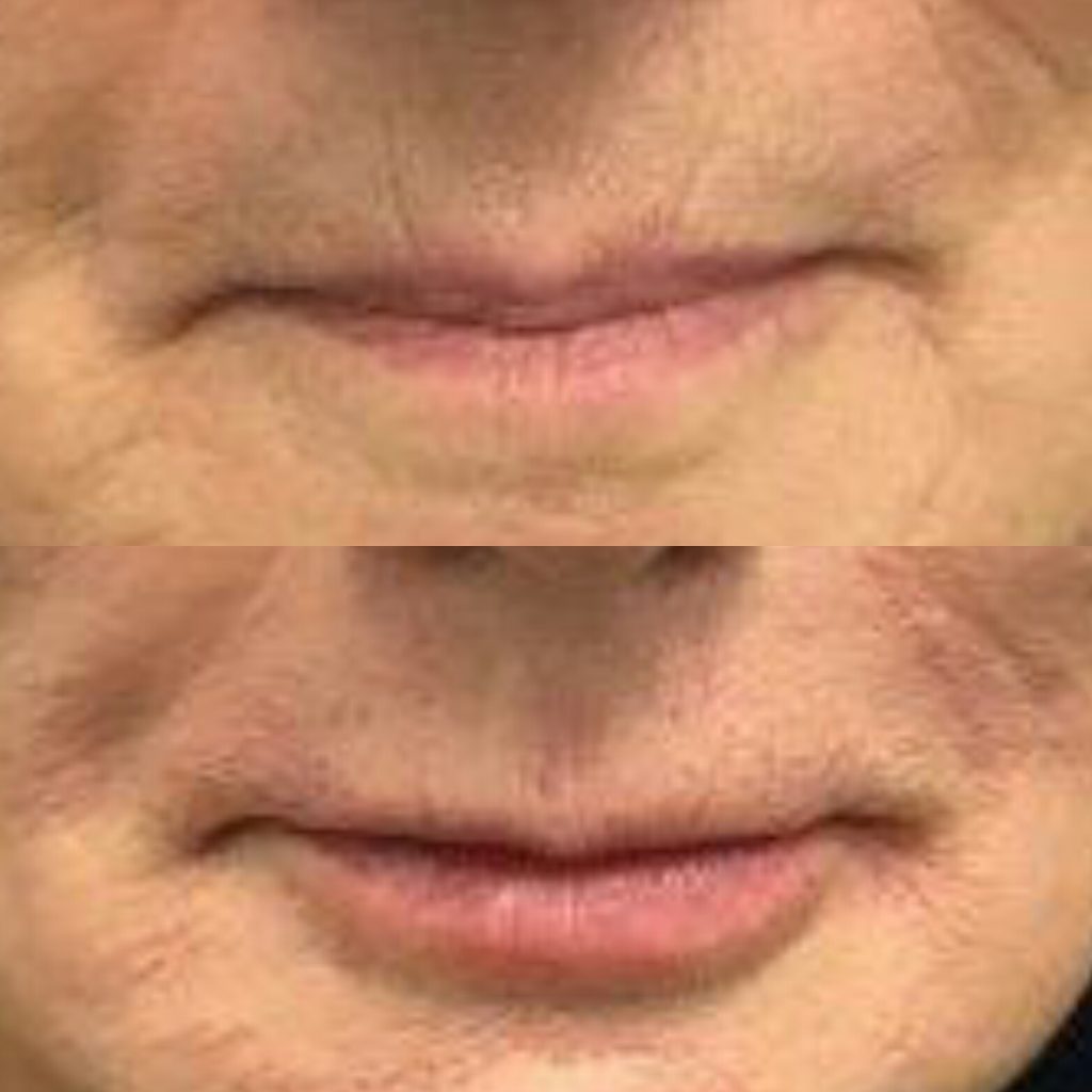 Lip Lines Filler Brisbane Filler, PDO Threads and Laser for Lip Wrinkles