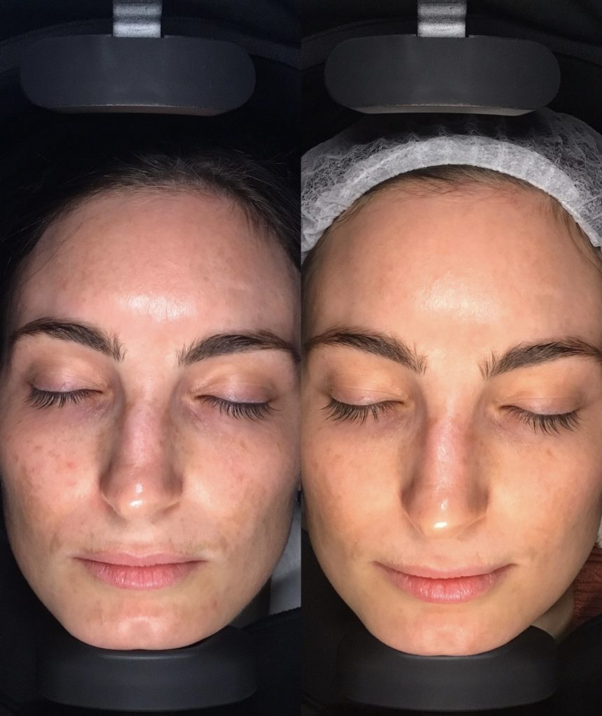 Laser Melasma Treatment Skin Care, Peels and Lasers for Melasma
