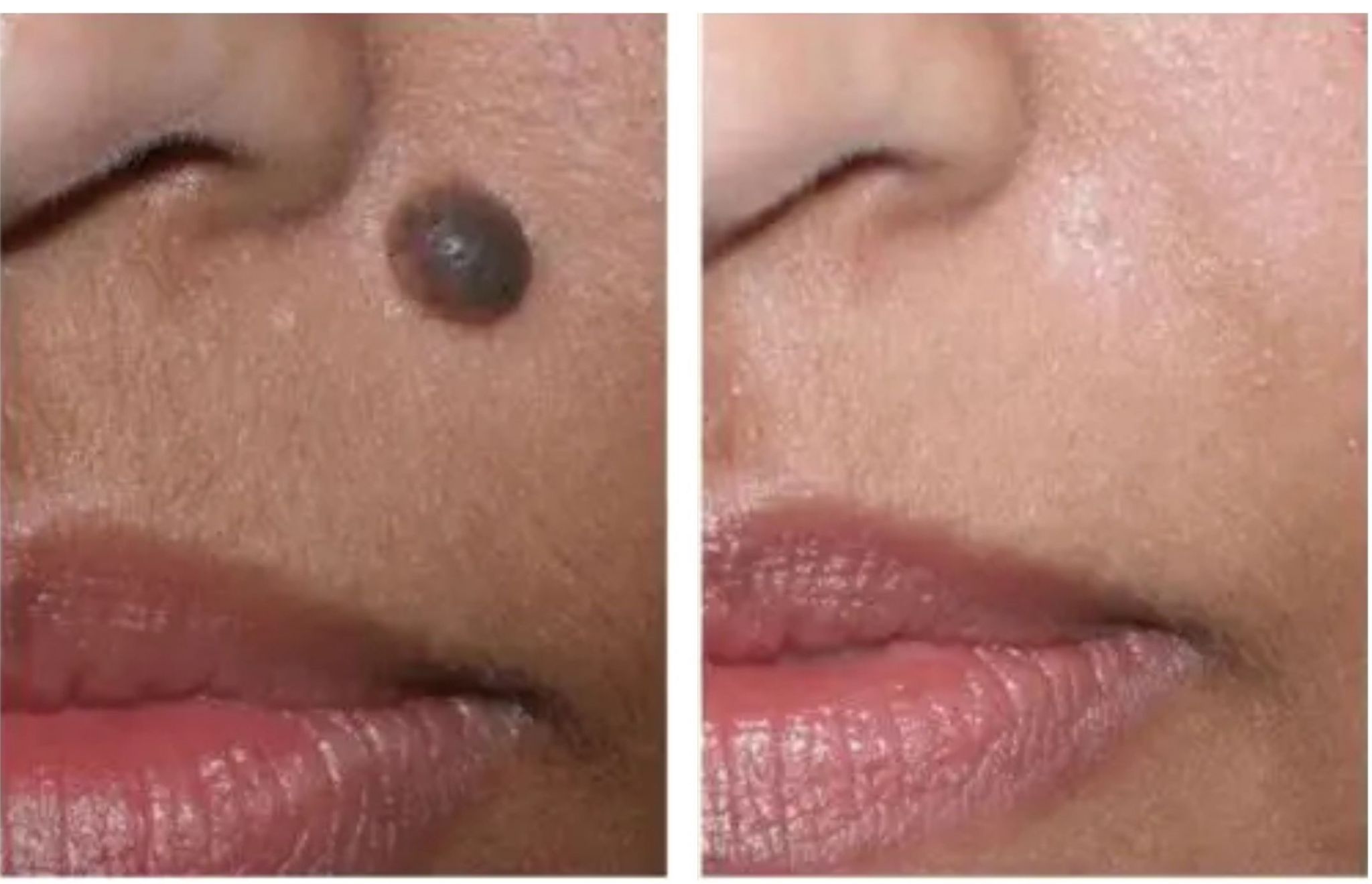 Mole Removal What To Expect Before And After Procedure UJPU