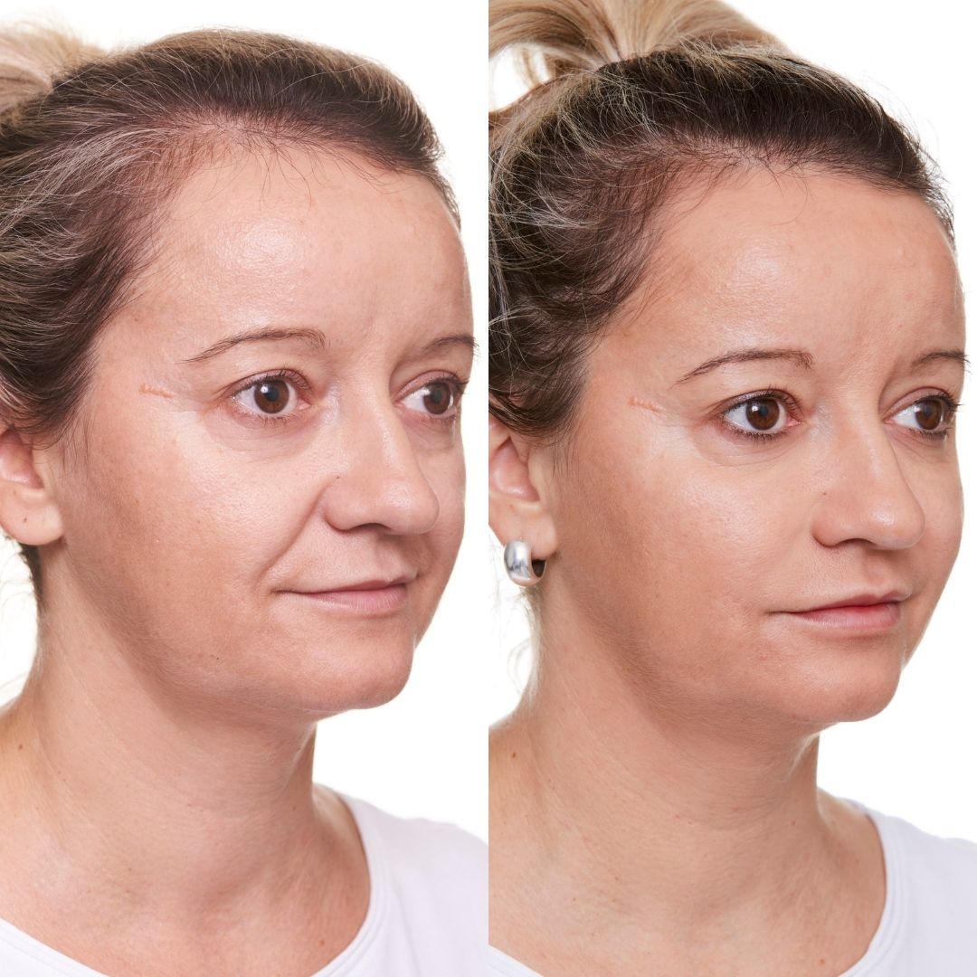 Nasolabial Fold Filler Brisbane PDO Threads, Cheek & Nasal Fold Filler