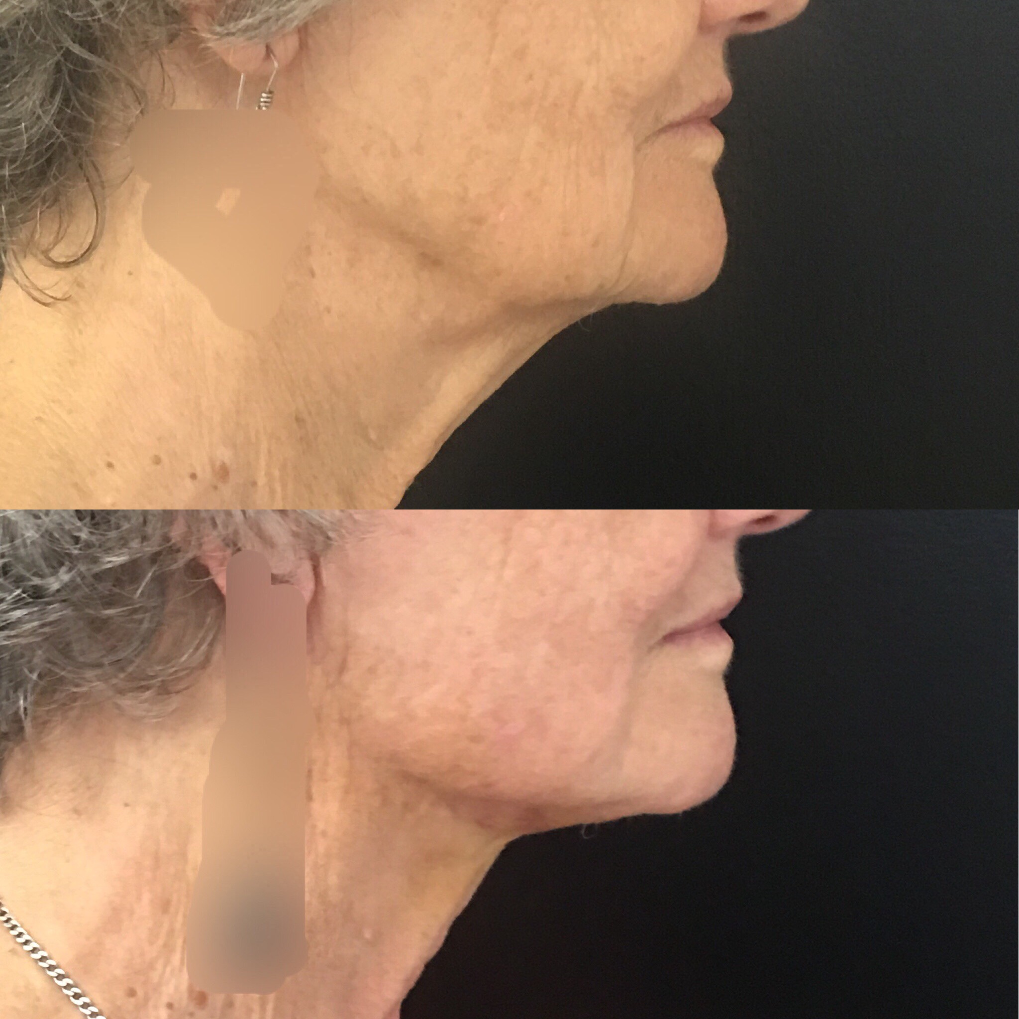 Thread Lift Brisbane Aptos, PDO & MINT Thread Facelift and Neck Lift