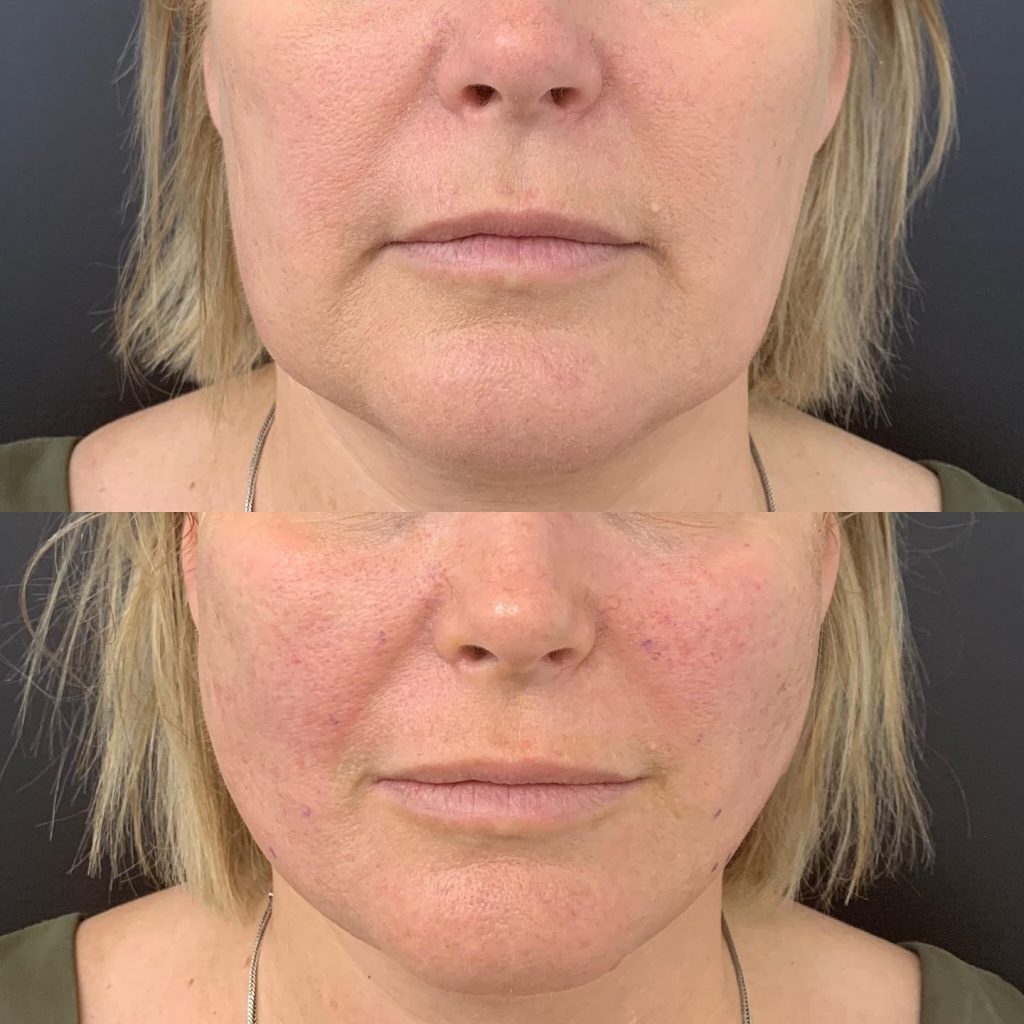 Nonsurgical Jowl Lift Thread Lift, HIFU, Injectables & Fillers for Jowl