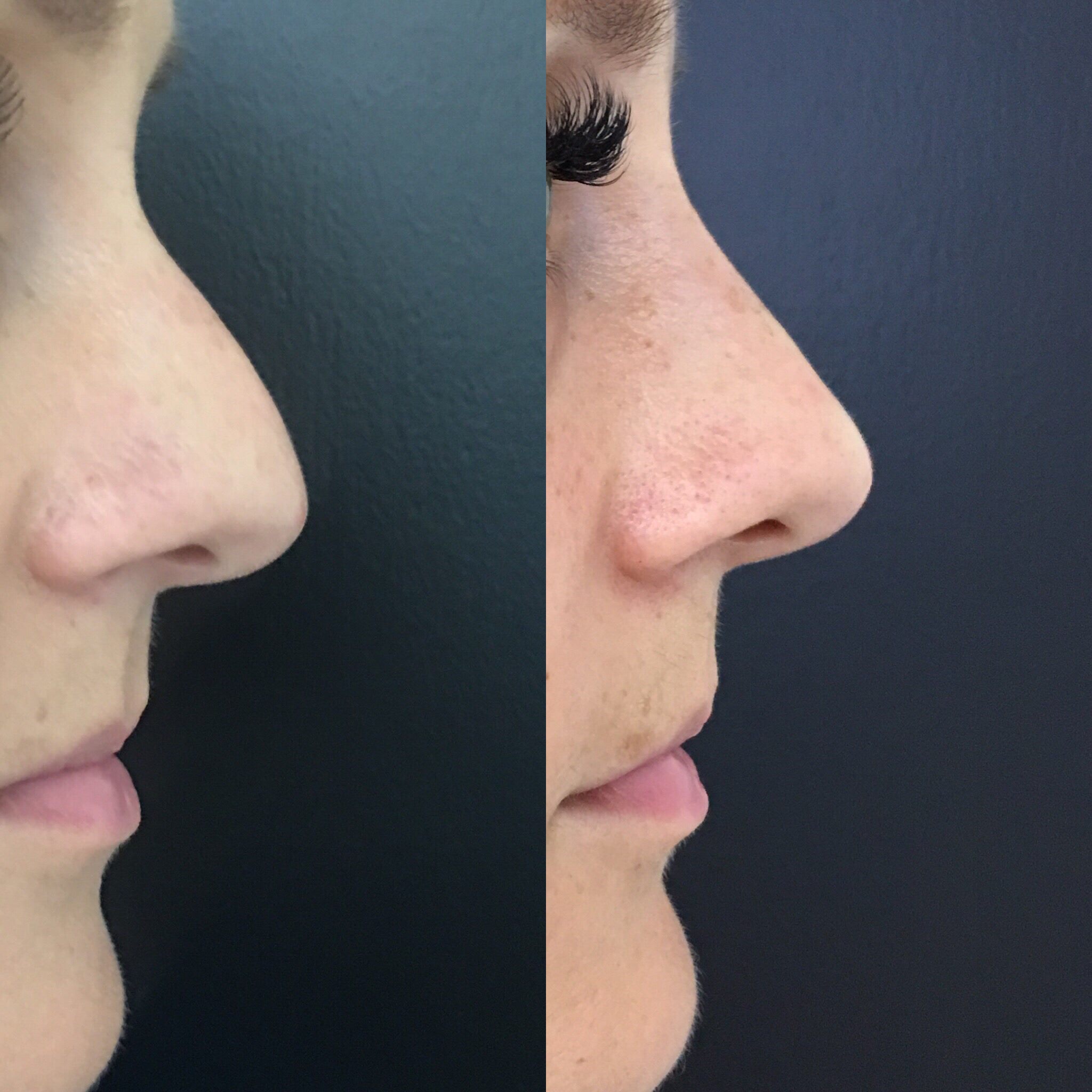 Non Surgical Nose Job Injectable Rhinoplasty & Nose Fillers