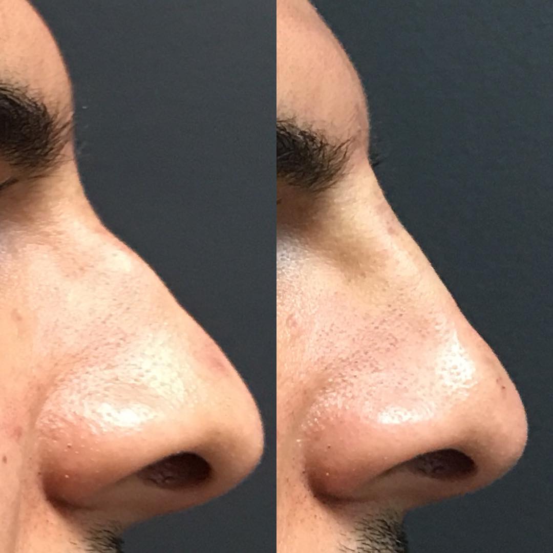 Non Surgical Nose Job Injectable Rhinoplasty & Nose Fillers