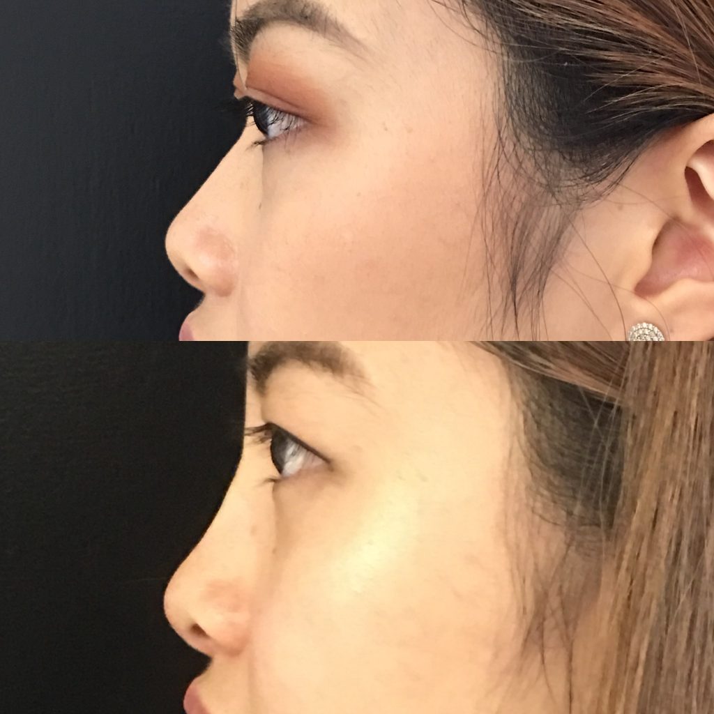 Non-Surgical Rhinoplasty | Nose Shaper, Nose Filler or Hiko Nose Thread