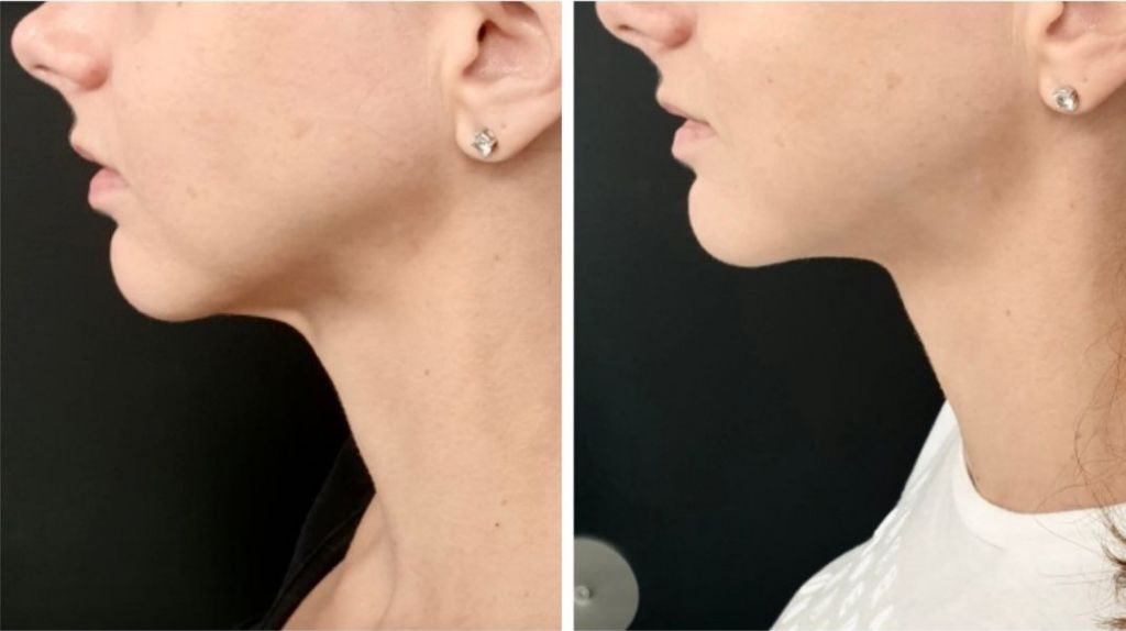 Korean Thread Facelift Brisbane, PDO Thread Lift or V Lift Facelift