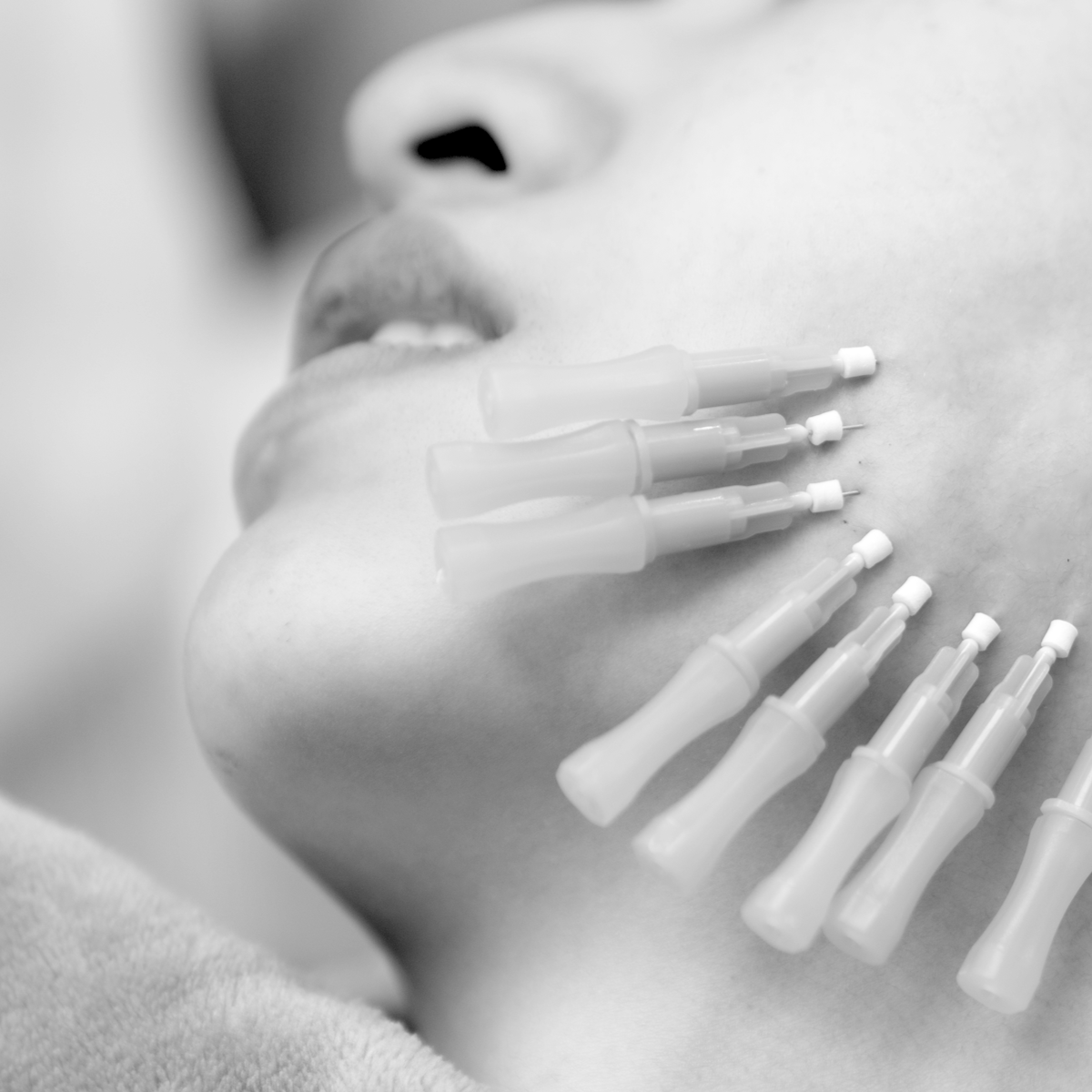 PDO Thread Lift with Mono Threads or Barbed PDO Threads