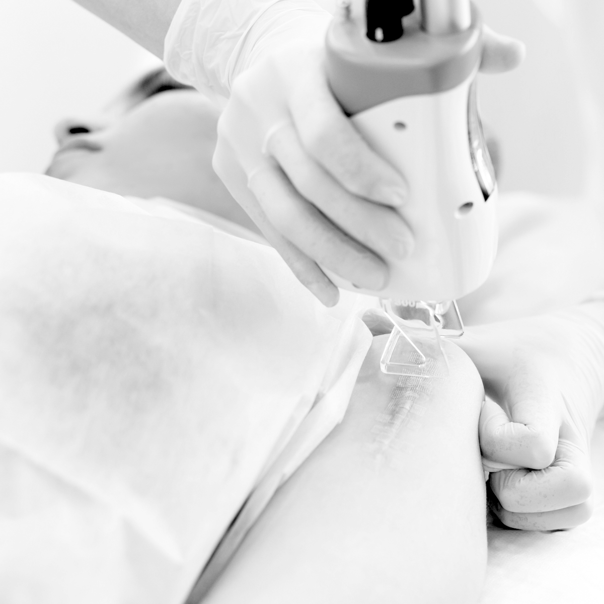 Laser Scar Removal Self Harm Scar Removal, Acne Scar & P.I.H