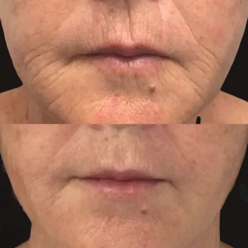 Smile Lines Filler, PDO Threads & Biostimulator Injection to Fill Smile