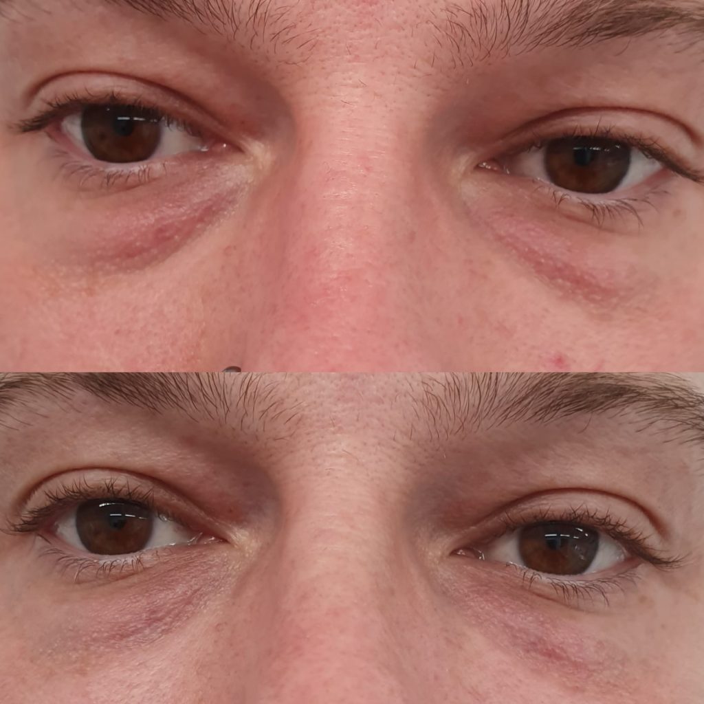 Under Eye Filler Best Eye Filler for Tear Troughs, Eye Bags & Wrinkles