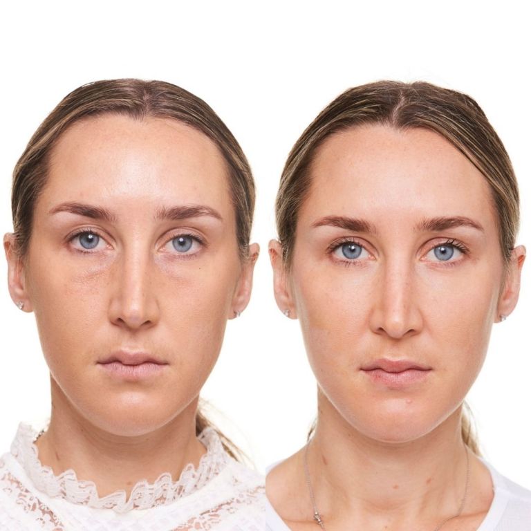 Tear Trough Filler for Dark Circles & Eye Bags Under Eye Wrinkles Filler