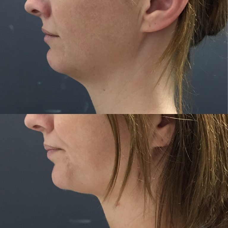 Nonsurgical Neck Lift Neck Tightening, Nefertiti Lift and Neck