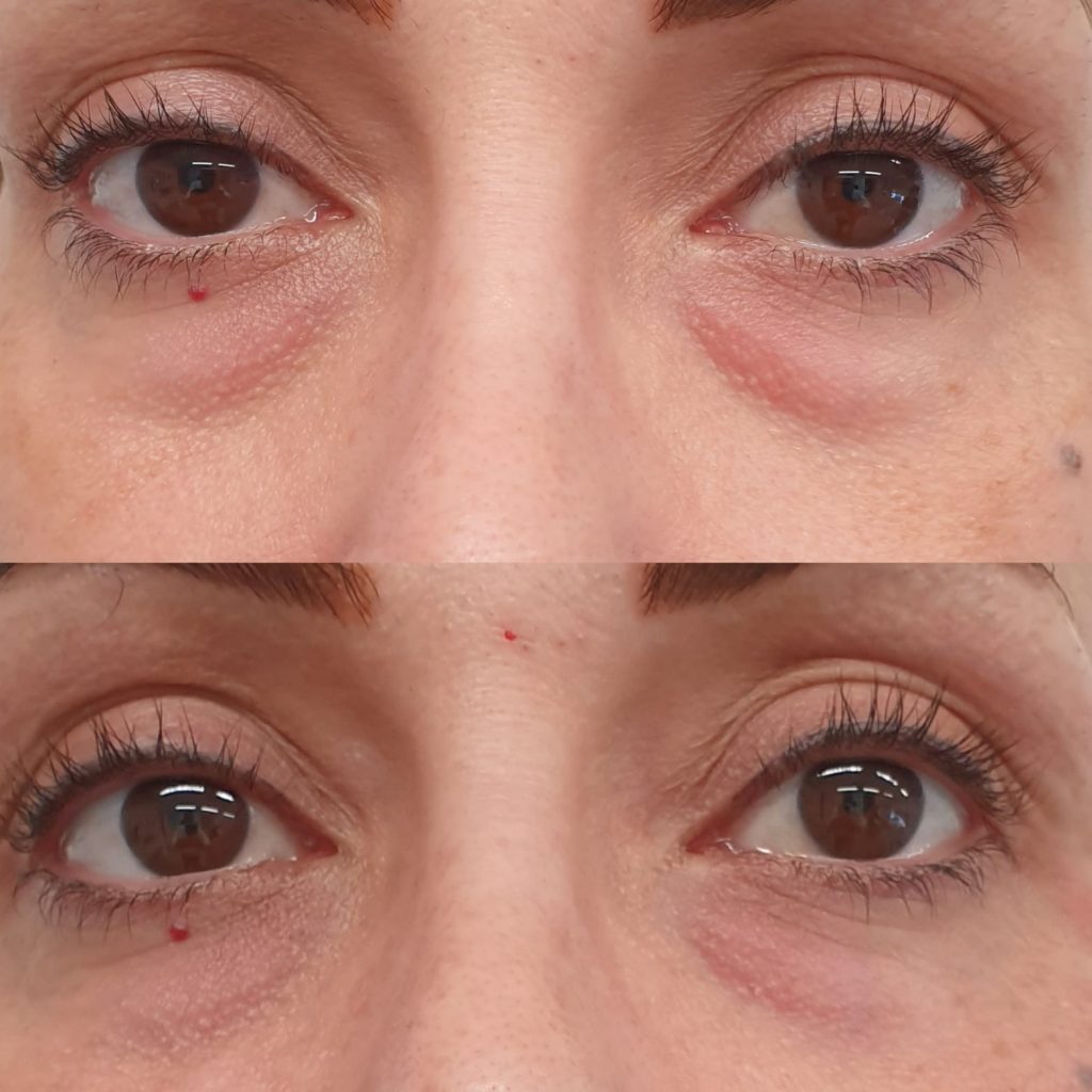 Under Eye Filler Best Eye Filler for Tear Troughs, Eye Bags & Wrinkles